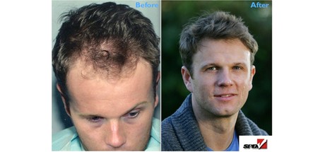 Worried about Hairloss?