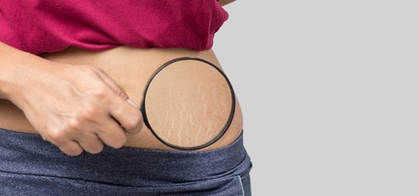 How Bio-Oil Improves The Appearance Of Stretch Marks and Scarring
