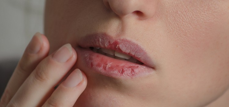 The Ultimate Dry Lip Therapy Guide