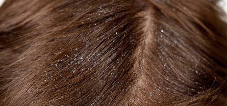 Dandruff Causes and Treatment