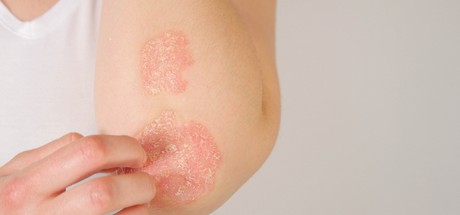 Psoriasis: Symptoms, Treatments and Causes