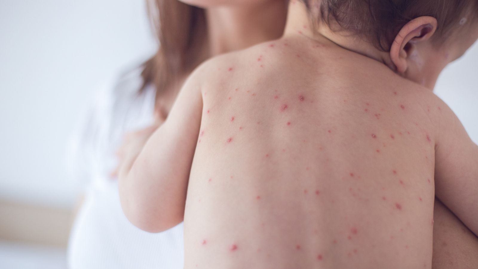 Symptoms & Stages of Chickenpox: a Guide for Adults & Children